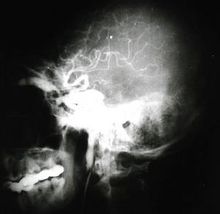 頸內動脈海綿竇瘺