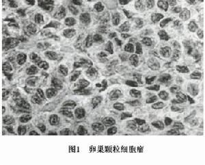 顆粒細胞瘤 顆粒細胞瘤