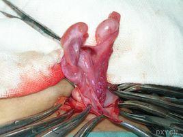 睪丸橫過移位 睪丸橫過移位