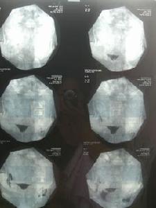 輸卵管結石 輸卵管結石