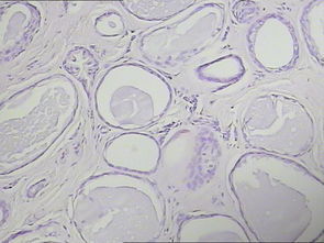 乳頭狀汗腺腺瘤 乳頭狀汗腺腺瘤