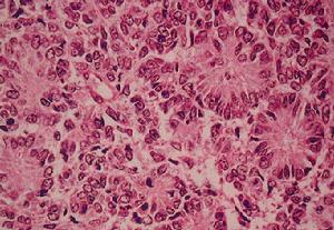 Ewing肉瘤 Ewing肉瘤