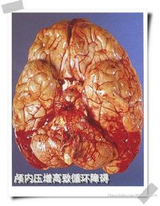 顱內壓增高綜合症