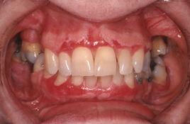 口腔炎症 口腔炎症