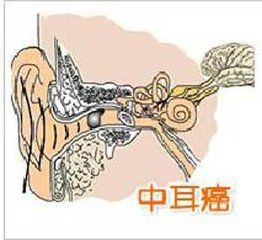 中耳癌 中耳癌