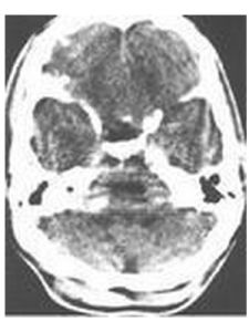 神經纖維瘤病 神經纖維瘤病