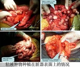 腹膜假粘液瘤 腹膜假粘液瘤