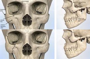 顴骨磷部 顴骨磷部