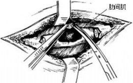 胸壁結核病灶清除術 胸壁結核病灶清除術