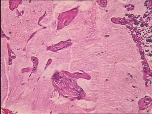 胃畸胎瘤 胃畸胎瘤