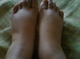 踝部及足背水腫 踝部及足背水腫