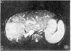 Budd-Chiari綜合徵