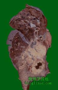 肺炎克雷白桿菌肺炎