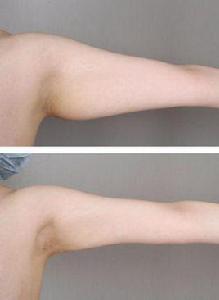 手臂吸脂術 手臂吸脂術