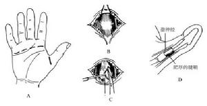 兒童狹窄性腱鞘炎 兒童狹窄性腱鞘炎