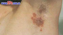 梅毒所致精神障礙 梅毒所致精神障礙