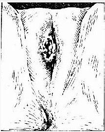 外陰瘙癢 外陰瘙癢