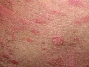 亞急性結節性遊走性脂膜炎 亞急性結節性遊走性脂膜炎