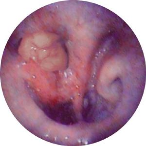 鼻咽癌的眼部病變