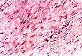 硬纖維瘤的病理表現