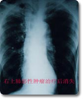 原發性支氣管肺癌