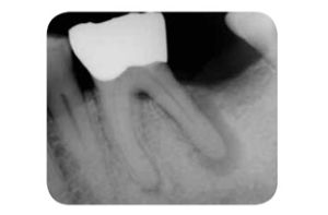 牙周牙髓聯合病變