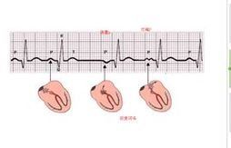 竇房結內遊走心律 竇房結內遊走心律