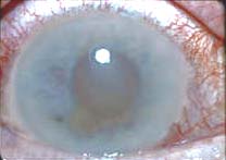 藥物相關性青光眼