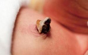 臍肉芽腫 臍肉芽腫