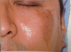 咖啡牛奶色斑 咖啡牛奶色斑