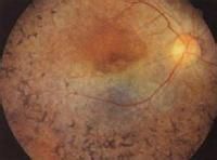 原發性視網膜色素變性