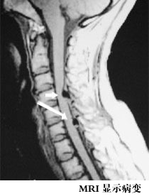 骨質增生症 骨質增生症