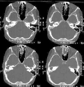 急性化膿性乳突炎