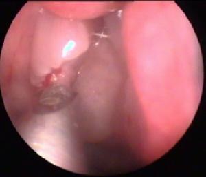 上頜竇後鼻孔息肉 上頜竇後鼻孔息肉