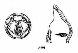 喉癌類型 喉癌類型