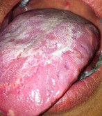 口腔白斑病 口腔白斑病