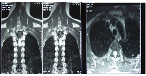 原發性椎管內腫瘤