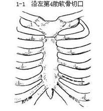心包切開引流術