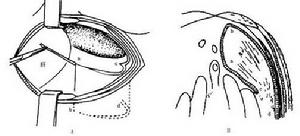 先天性胸腹裂孔疝