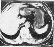 （圖）胃脂肪瘤