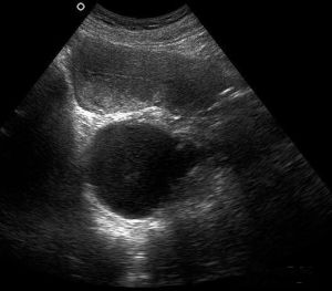 非贅生性囊腫 非贅生性囊腫