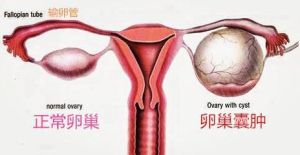 卵巢疾病 卵巢疾病