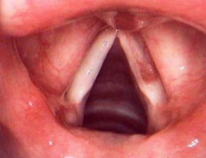 聲帶息肉 聲帶息肉