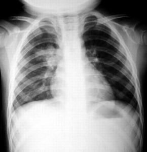 肺炎X光片