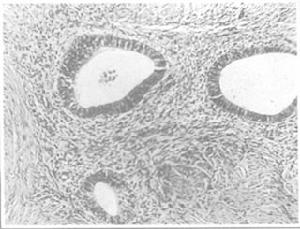 （圖）子宮腺肌病