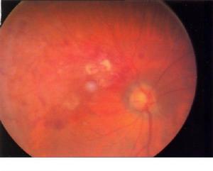 新生血管性青光眼