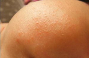 嬰兒熱疹 嬰兒熱疹