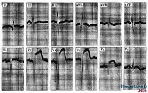 老年急性心肌梗死