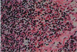 Russell小體 Russell小體