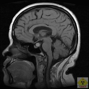 耳源性腦膿腫 耳源性腦膿腫